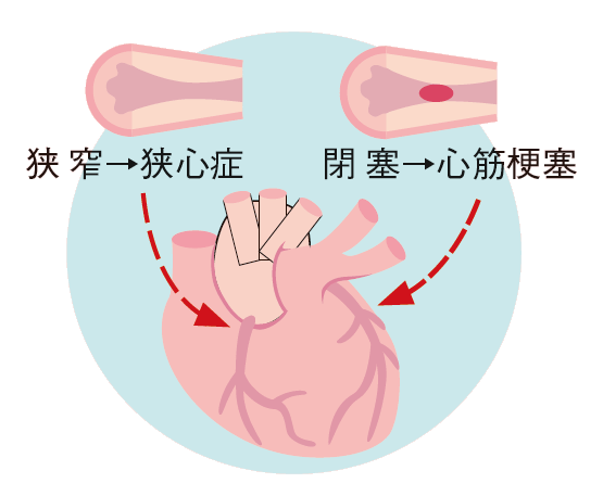 狭窄から狭心症、閉塞から心筋梗塞についてのイラスト