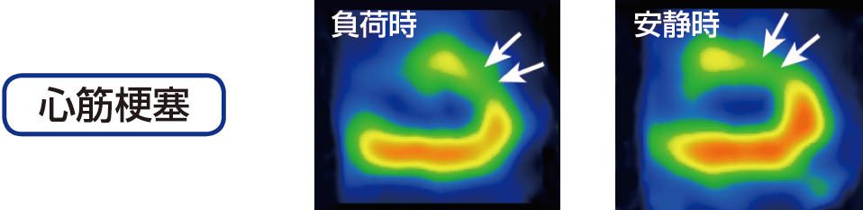 心筋梗塞時の負荷時と安静時の心筋シンチグラフィ画像