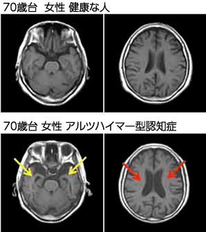 もの忘れ が気になる方々へ 日本メジフィジックス株式会社