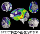 SPECT検査の画像診断写真