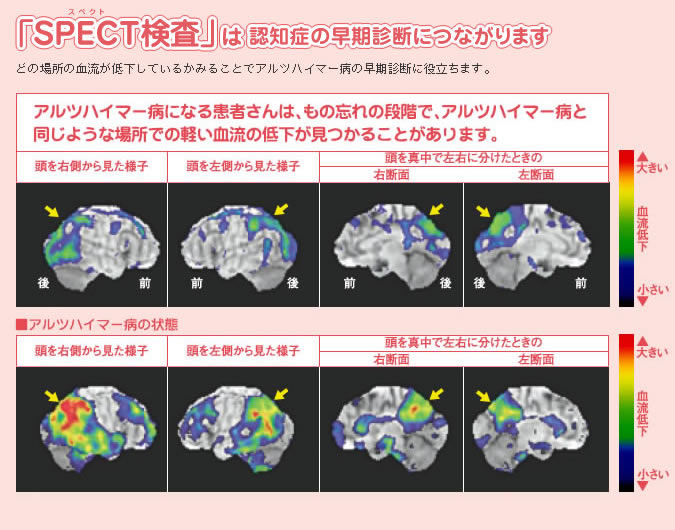 「SPECT検査」は認知症の早期診断につながります