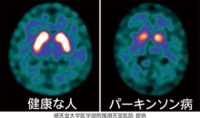 健康な人 パーキンソン病 順天堂大学医学部附属天堂医院 提供