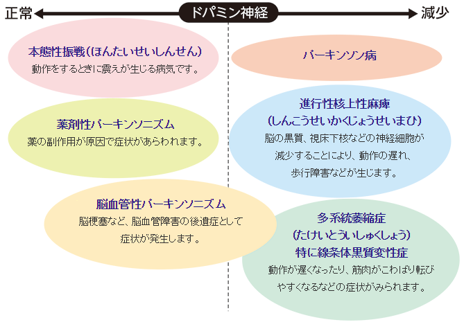 病 進行 パーキンソン