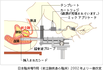 密封小線源療法の図解