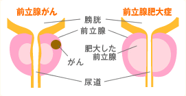 前立腺肥大症の図解