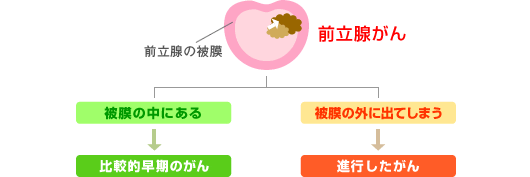 前立腺がんの進行度の図