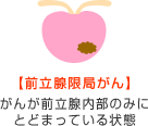 【前立腺限局がん】がんが前立腺内部のみにとどまっている状態