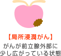 【局所浸潤がん】がんが前立腺外部に少し広がっている状態