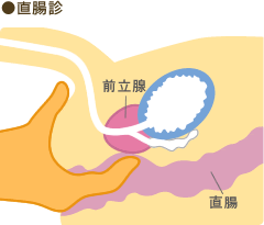 直腸診の図解