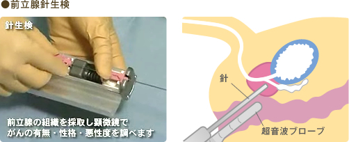 前立腺針生検の図解