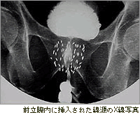 前立腺内に挿入された線源のX線写真