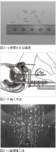 小線源療法の概要