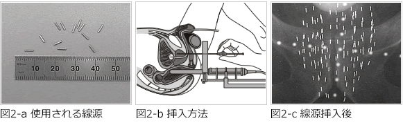 小線源療法の概要