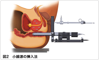 図2　小線源の挿入法