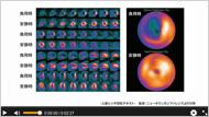 冠動脈支配領域と一致する所見