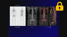 VSBONE BSIによる骨転移治療効果判定と有用性