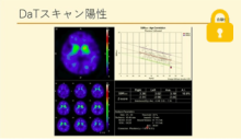 高齢発症うつ症例の紹介 サムネイル