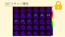 VLOSLP(最遅発性統合失調症様精神病) サムネイル