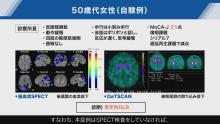 精神疾患と診断され、SPECT検査でDLBと診断できた症例