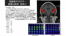 症例2「高齢者タウオパチー」