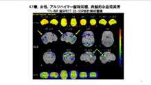 アルツハイマー型認知症(AD)とレビー小体型認知症(DLB)鑑別診断のための脳SPECT検査所見 SPECTスライド