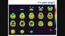 脳SPECT検査が“もの忘れ”の背景要因の診断根拠となった活用事例