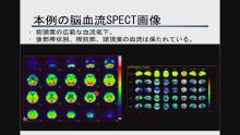 脳SPECT活用事例：行動障害型FTD　サムネイル