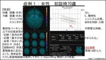 DaT-SPECT活用事例：精神症状で発症したDLB　サムネイル