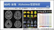 脳血流SPECTによる血流低下所見を症状と結びつける サムネイル