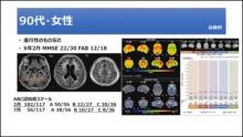 脳血流SPECTを背景病理の把握に役立てる サムネイル