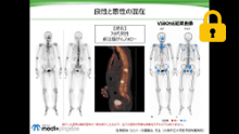 斜位の有効性とSPECTの意義 サムネイル