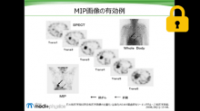 MIPの注意点 サムネイル