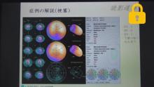 症例の解説(梗塞)　サムネイル
