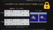 QGS,心筋外集積の影響　サムネイル