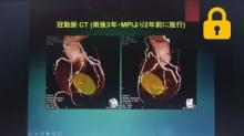 症例2 70歳台男性 検査目的 胃がん,術前心精査　サムネイル