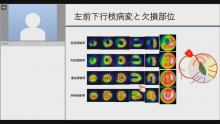 冠動脈灌流域の推定 サムネイル