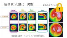 症例8 70歳代 男性 薬剤負荷99mTc-SPECT、虚血所見のスコア化とエビデンスの活用