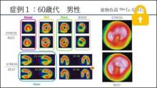 症例1 60歳代 男性 薬剤負荷99mTc-SPECT