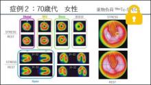 症例2 70歳代 女性 薬剤負荷99mTc-SPECT　サムネイル