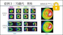 症例3 70歳代 男性 薬剤負荷99mTc-SPECT