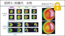 症例5 80歳代 女性 薬剤負荷99mTc-SPECT　サムネイル