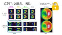 症例7 70歳代 男性 運動負荷99mTc-SPECT