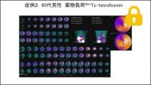 症例2 60歳代男性 薬物負荷99mTc-tetrofosmin　サムネイル