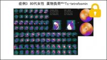 症例3 80歳代女性 薬物負荷99mTc-tetrofosmin　サムネイル