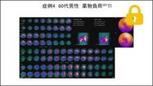 症例4 60歳代男性 薬物負荷201Tl サムネイル