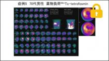 症例5 70歳代男性 薬物負荷99mTc-tetrofosmin　サムネイル