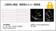 冠動脈CTファースト時代の心筋シンチグラフィ検査の意義1 サムネイル