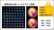 冠動脈CTファースト時代の心筋シンチグラフィ検査の意義2 サムネイル