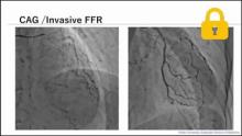 心筋シンチグラフィ検査とFFRCTの使い分け サムネイル