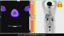 Case2 外耳道扁平上皮癌 staging